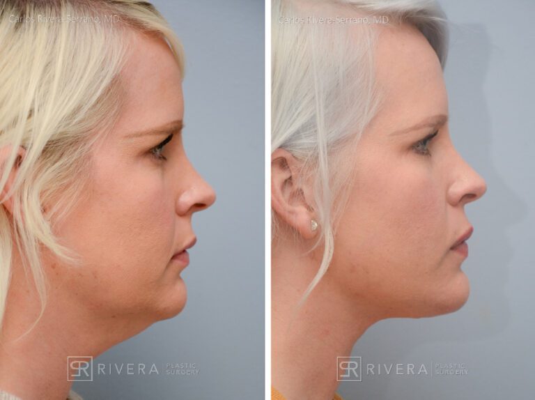 Neck lift, Dual plain (deep and superficial) neck lift. There is only one hidden scar below the chin. No other scars. - Woman - Case 12201 - Before and after - Lateral view