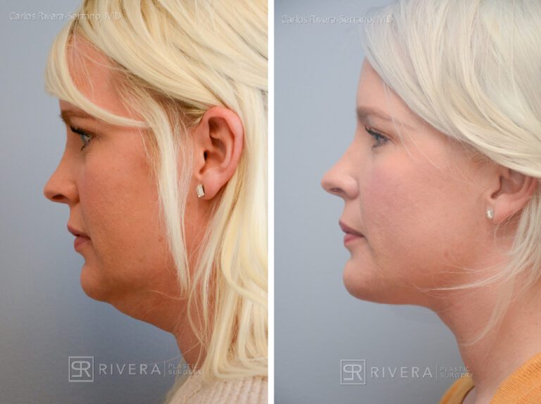 Neck lift, Dual plain (deep and superficial) neck lift. There is only one hidden scar below the chin. No other scars. - Woman - Case 12201 - Before and after - Lateral view