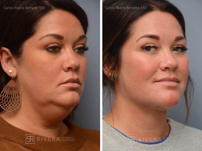 Neck lift, Dual plain (deep and superficial) neck lift. There is only one hidden scar below the chin. No other scars. - Woman - Case 12202 - Before and after - Oblique view