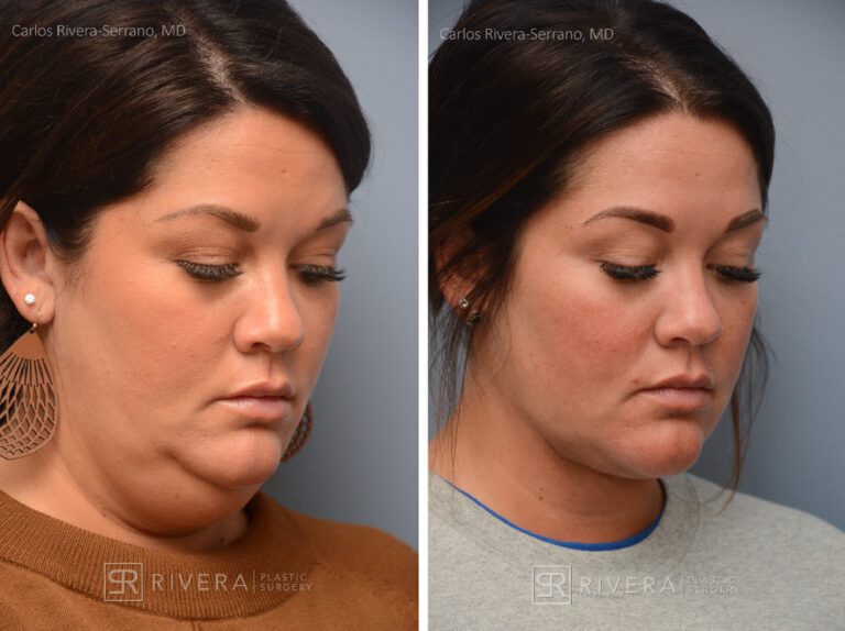 Neck lift, Dual plain (deep and superficial) neck lift. There is only one hidden scar below the chin. No other scars. - Woman - Case 12202 - Before and after - Oblique view