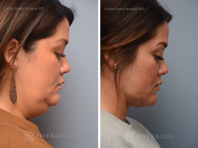 Neck lift, Dual plain (deep and superficial) neck lift. There is only one hidden scar below the chin. No other scars. - Woman - Case 12202 - Before and after - Lateral view