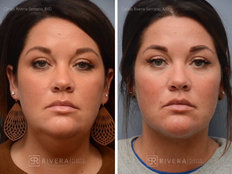 Neck lift, Dual plain (deep and superficial) neck lift. There is only one hidden scar below the chin. No other scars. - Woman - Case 12202 - Before and after - Frontal view