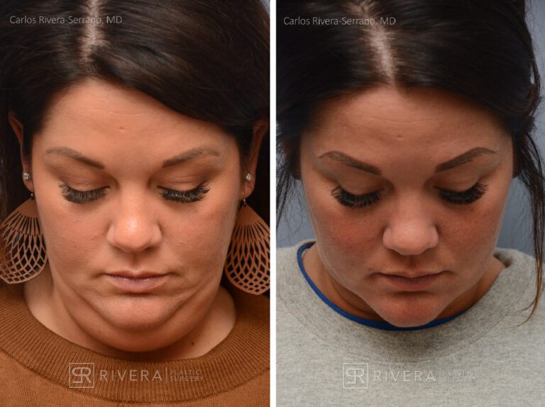 Neck lift, Dual plain (deep and superficial) neck lift. There is only one hidden scar below the chin. No other scars. - Woman - Case 12202 - Before and after - Superior view