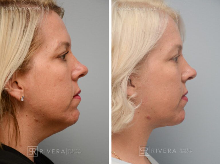 Neck lift, Dual plain (deep and superficial) neck lift. There is only one hidden scar below the chin. No other scars. - Woman - Case 12203 - Before and after - Lateral view