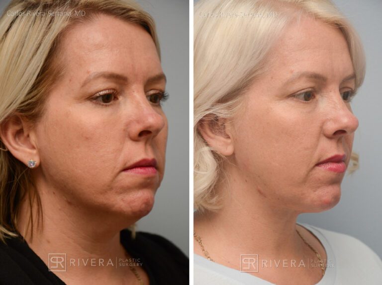 Neck lift, Dual plain (deep and superficial) neck lift. There is only one hidden scar below the chin. No other scars. - Woman - Case 12203 - Before and after - Oblique view