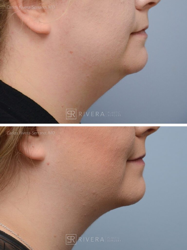 Removal of large face/neck lipoma - Woman - Case 12301 - Before and after - Lateral view