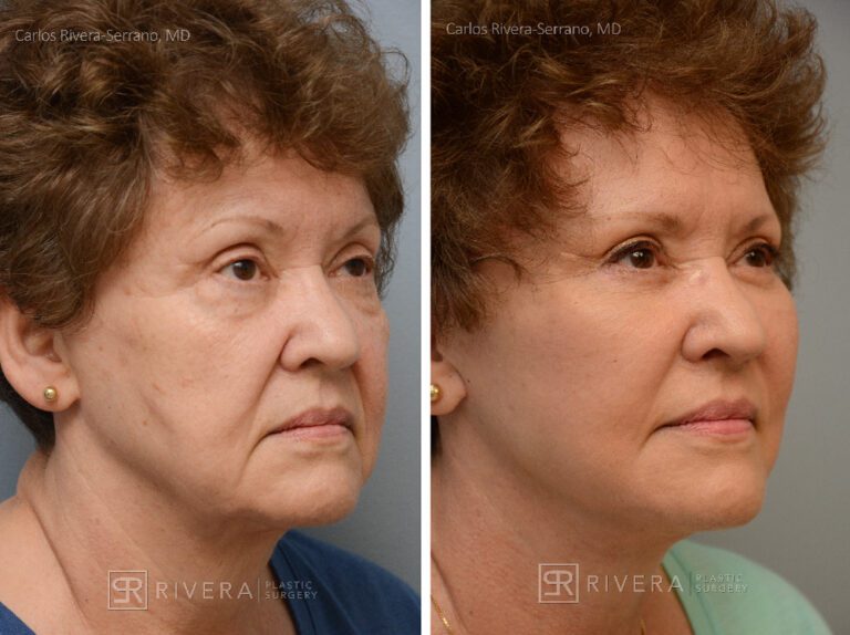 Patient with prior facelift. Facelift, lower eyelid surgery, lateral brow lift. Notice the correction of the bad scars behing the ears from a prior facelift. - Woman - Case 11201 - Before and after - Oblique view