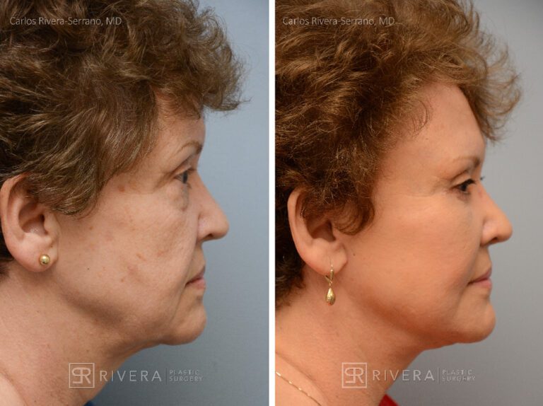 Patient with prior facelift. Facelift, lower eyelid surgery, lateral brow lift. Notice the correction of the bad scars behing the ears from a prior facelift. - Woman - Case 11201 - Before and after - Profile view
