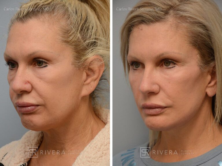 Patient with prior facelift. Facelift, lower eyelid surgery, temporal (temple) lift. Notice the correction of the "pixie" ears and bad scars from a prior facelift - Woman - Case 11202 - Before and after - Oblique view