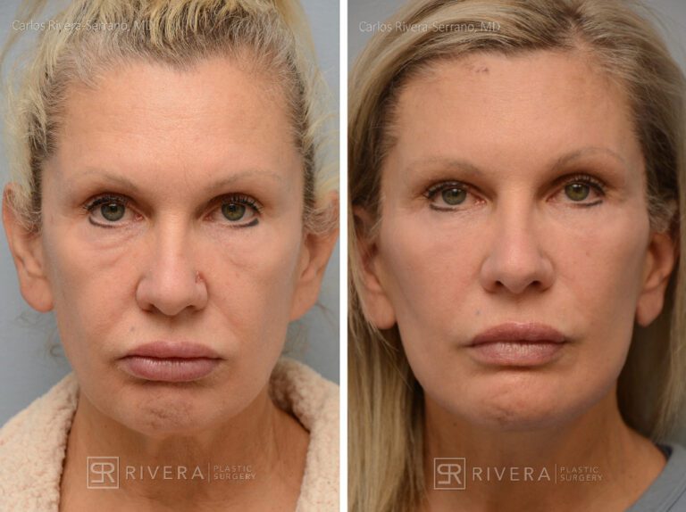 Patient with prior facelift. Facelift, lower eyelid surgery, temporal (temple) lift. Notice the correction of the "pixie" ears and bad scars from a prior facelift - Woman - Case 11202 - Before and after - Frontal view