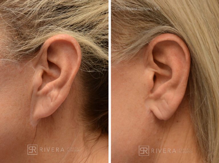 Patient with prior facelift. Facelift, lower eyelid surgery, temporal (temple) lift. Notice the correction of the "pixie" ears and bad scars from a prior facelift - Woman - Case 11202 - Before and after - Profile view