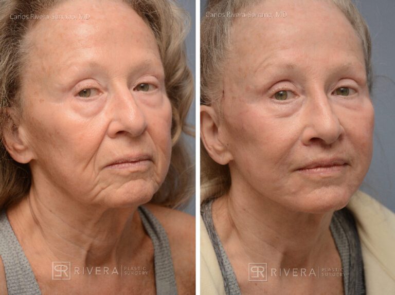 Patient with prior facelift: Facelift, TCA peel, lip lift, hyaluronic acid fillers around mouth and in nose - Woman - Case 11203 - Before and after - Oblique view