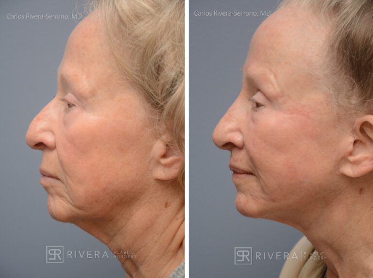 Patient with prior facelift: Facelift, TCA peel, lip lift, hyaluronic acid fillers around mouth and in nose - Woman - Case 11203 - Before and after - Profile view