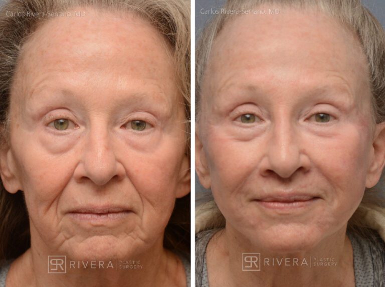 Patient with prior facelift: Facelift, TCA peel, lip lift, hyaluronic acid fillers around mouth and in nose - Woman - Case 11203 - Before and after - Frontal view