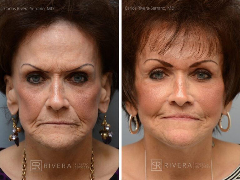 Patient with prior facelift: Facelift, lip lift, facial fat transfer (grafting (2 sessions), brow lift. Notice the correction of the bad scars behing the ears from a prior facelift. - Woman - Case 11204 - Before and after - Frontal view
