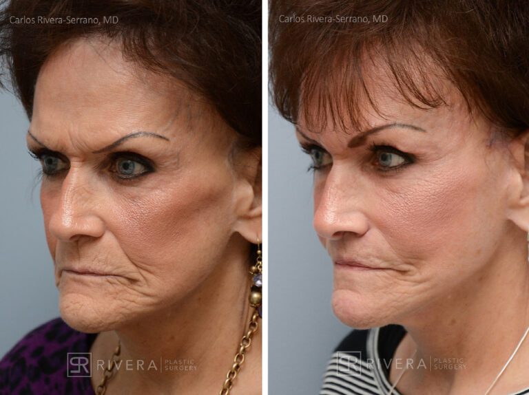 Patient with prior facelift: Facelift, lip lift, facial fat transfer (grafting (2 sessions), brow lift. Notice the correction of the bad scars behing the ears from a prior facelift. - Woman - Case 11204 - Before and after - Oblique view