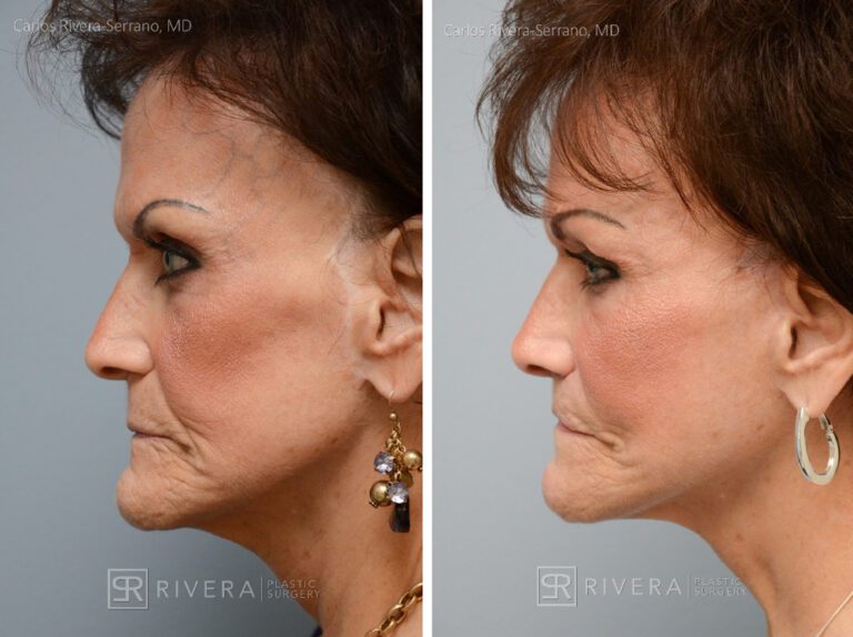 Patient with prior facelift: Facelift, lip lift, facial fat transfer (grafting (2 sessions), brow lift. Notice the correction of the bad scars behing the ears from a prior facelift. - Woman - Case 11204 - Before and after - Profile view