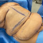 Abdominoplasty & liposuction in female patient - Tummy tuck lipoabdominoplasty - pre operative case 8 - frontal view