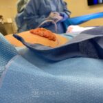 Chest Reduction Surgery for Men (Gynecomastia) - Man - Case 21102 - Intraoperative - Superior view
