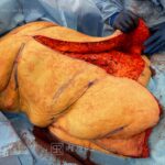 Abdominoplasty & liposuction in female patient - Tummy tuck lipoabdominoplasty - intra operative 8 - frontal view