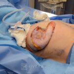 Abdominoplasty (tummy tuck) breast lift with implants - Woman - Case 2902 - Preoperative - Lateral view