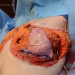 Abdominoplasty (tummy tuck) breast lift with implants - Woman - Case 2902 - Preoperative - Frontal view