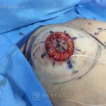 Congenital breast asymmetry treated with 3 rounds of left breast fat grafting- fat transfer and a right breast lift to improve symmetry - Woman - Case 2202 - Intraoperative - Oblique view