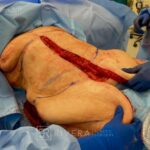 Abdominoplasty & liposuction for woman - Tummy tuck lipoabdominoplasty - intra operative case 8 - frontal view