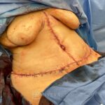Abdominoplasty & liposuction for woman - Tummy tuck lipoabdominoplasty - intra operative case 8 - frontal view