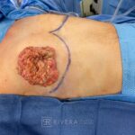 Chest Reduction Surgery for Men (Gynecomastia) - Man - Case 21102 - Intraoperative - Lateral view