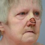 Nose reconstruction from skin cancer removal with Paramedian Forehead flap - Woman - Case 16502 - Intraoperative - Oblique view
