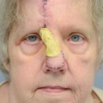 Nose reconstruction from skin cancer removal with Paramedian Forehead flap - Woman - Case 16502 - Intraoperative - Frontal view