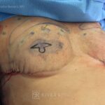 Bilateral nipple recosntruction and areaola tattoo - Woman - Case 26403 - Intraoperative - Inferior view