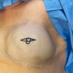 Bilateral nipple recosntruction and areaola tattoo - Woman - Case 26402 - Intraoperative- Oblique view