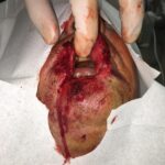 Upper lip reconstruction from complex traumatic injury with primary closure - Man - Case 19209 - Intraoperative - Frontal view