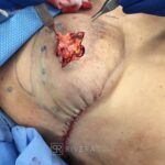Bilateral nipple recosntruction and areaola tattoo - Woman - Case 26403 - Intraoperative - Oblique view