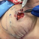 Bilateral nipple recosntruction and areaola tattoo - Woman - Case 26403 - Intraoperative - Frontal view
