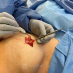 Bilateral nipple recosntruction and areaola tattoo - Woman - Case 26402 - Intraoperative - Oblique view