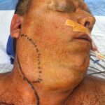 Lipoma surgery on face and neck in man - Skin cancer - Lipomas - Preoperative case 1 - right lateral view