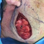 Lipoma surgery on face and neck in man - Skin cancer - Lipomas - Intraoperative case 1 - right lateral view