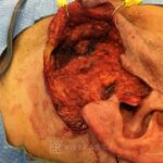 Superficial parotidectomy with facial nerve dissection - Man - Case 8806 - Intraoperative - Lateral view