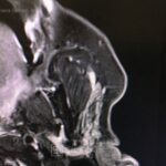 Superficial parotidectomy with facial nerve dissection - Man - Case 8805 - X-Ray - Lateral view