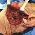 Superficial parotidectomy with facial nerve dissection - Man - Case 8803 - Intraoperative - Lateral view