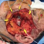 Superficial parotidectomy with facial nerve dissection - Man - Case 8805 - Intraoperative - Lateral view