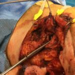 Superficial parotidectomy with facial nerve dissection - Man - Case 8806 - Intraoperative - Lateral view