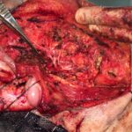 Superficial parotidectomy with facial nerve dissection - Man - Case 8808 - Intraoperative - Lateral view