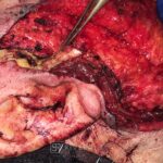 Superficial parotidectomy with facial nerve dissection - Man - Case 8808 - Intraoperative - Lateral view