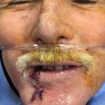 Lower lip reconstruction from skin cancer removal with local Advancement flaps - Man - Case 19204 - Intraoperative- Frontal view