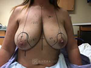 Bilateral breast reduction superomedial dermoglandular pedicle, Wise skin pattern approach (inverted T) - Woman - Case 2305 - Preoperative - Frontal view