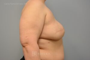 Right Mastectomy & reconstruction with implant - Woman - Case 26108 - Intraoperative – Lateral view